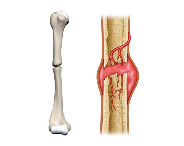 Understanding Bone Nonunion: Why Some Fractures Do Not Heal, and How They Are Treated